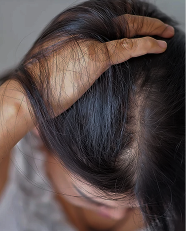 Stop Hair Thinning &amp; Support Growth